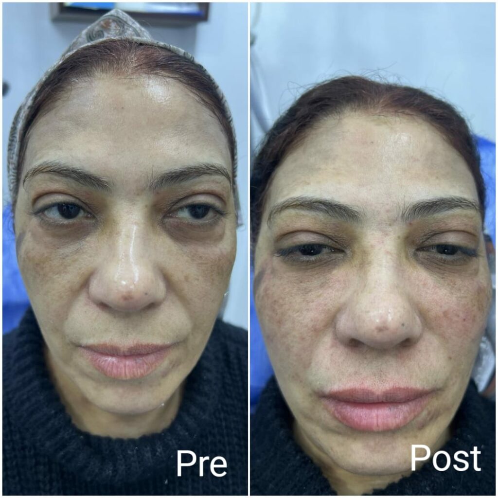 Cheek fillers before and after